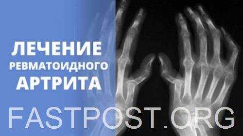 Уникальное лечение ревматоидного артрита народными средствами и питанием
